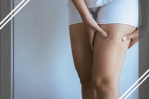 moça com short branco mostrando celulite na perna após tratamento com SlimForce Fluido Power 360