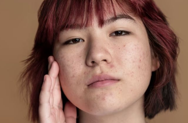 Guia da acne: menina com a pele com acne