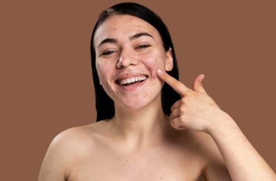 Mulher jovem passando ativos para acne no rosto enquanto sorri